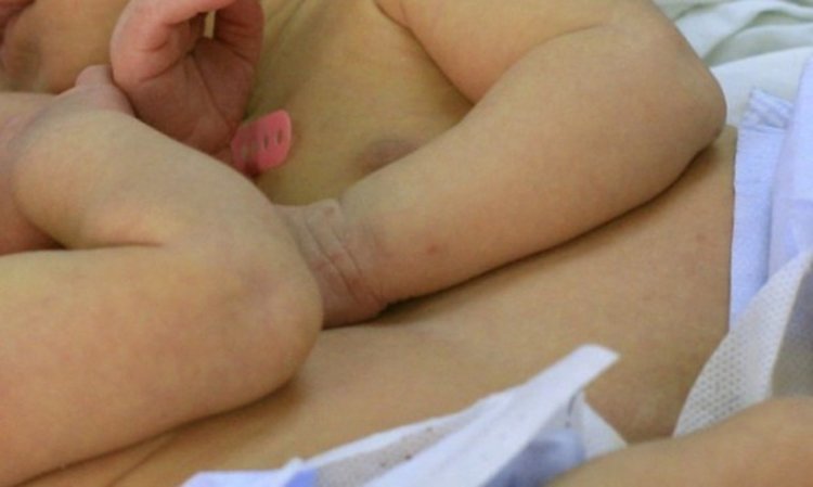 След 6 месеца: Разделят сиамските близнаци Богдан и Янчо?