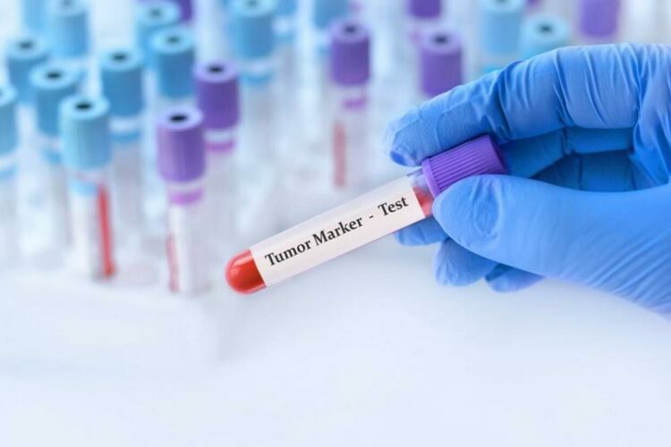 Лекари и пациенти настояват Здравната каса да заплаща биомаркерните изследвания за някои видове рак